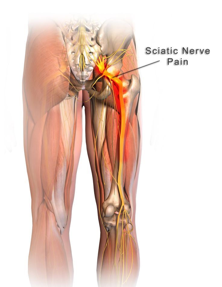 Calmya works wonder on sciatica pain